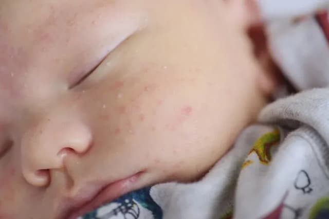 Alergia pokarmowa u niemowlaka objawy - jak je rozpoznać i co robić